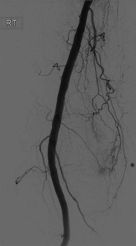 How Effective Is Genicular Artery Embolization Gae Vascular And