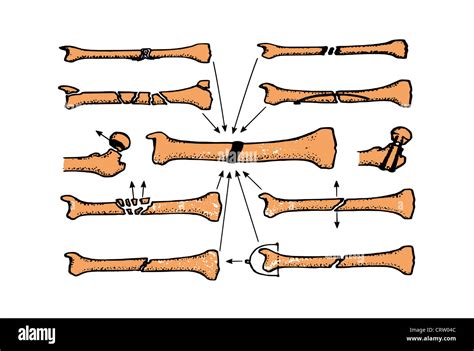 Comminuted Bone Fracture Cut Out Stock Images Pictures Alamy