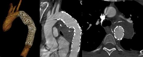 Tevar For Traumatic Thoracic Injury With The First Generation Stent