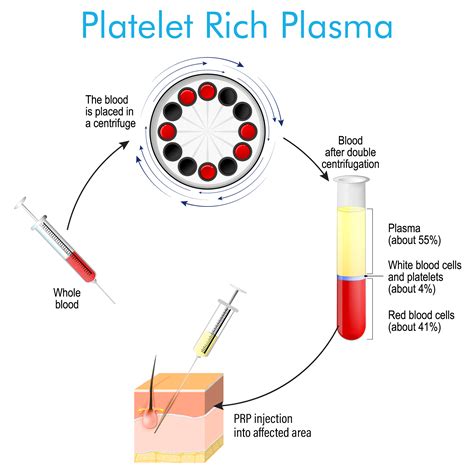 Prp Platelet Rich Plasma Kochan Pain Treatment Center