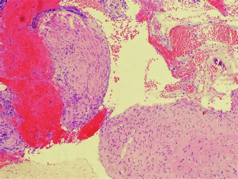 A This Micrograph Illustrates Nodules Of Cartilage In Varying Sizes