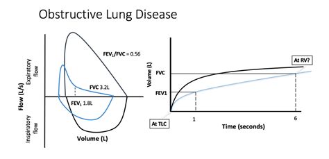 Spirometry Obstructive Pattern | Hot Sex Picture