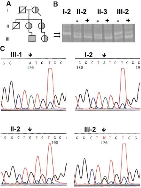 Table 1 From Familial Skewed X Chromosome Inactivation As A Predisposing Factor For Late Onset X