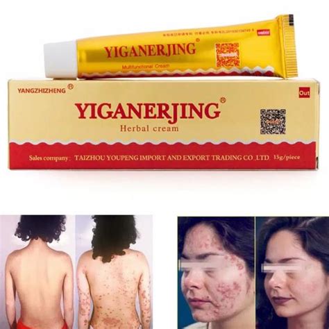 Jual Yiganerjing Obat Penyakit Kulit Psoriasis Eksim Dermatitis Eczema