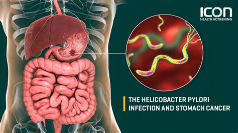 The Helicobacter Pylori Infection And Stomach Cancer Icon Health