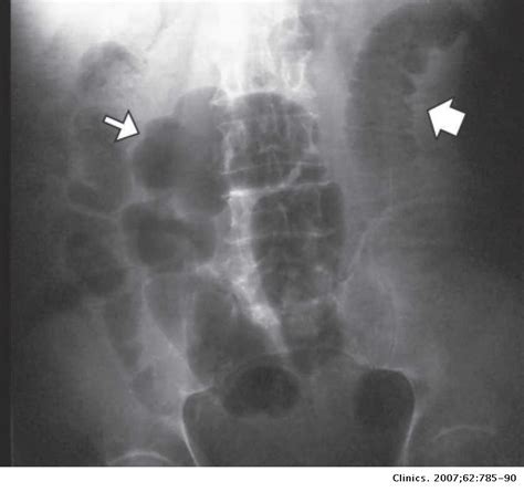 Spontaneous Intramural Small Bowel Hematoma Induced By Anticoagulant