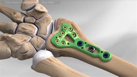 Arthrex Distal Radius Fracture Repair Volar Plate