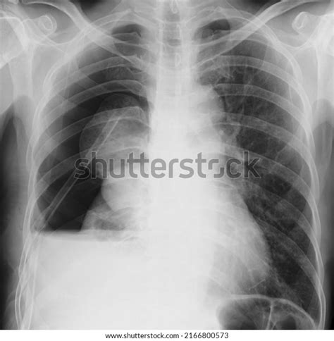 Chest X Ray Hydropneumothorax