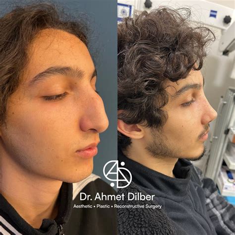 Rhinoplasty Result Dr Ahmet Dilber Rhinoplasty Plastic Surgery