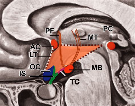 Lesions Of The Hypothalamus Mr Imaging Diagnostic Features Radiographics