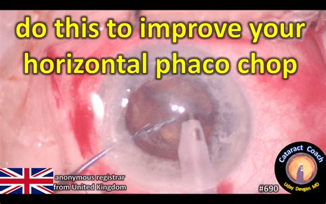 Resident Case Improve Horizontal Chop Cataract Coach™