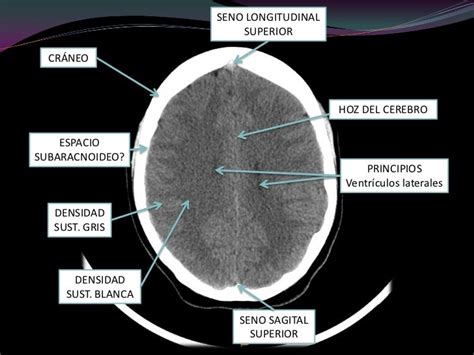 Interpretacion De Tac Cerebro