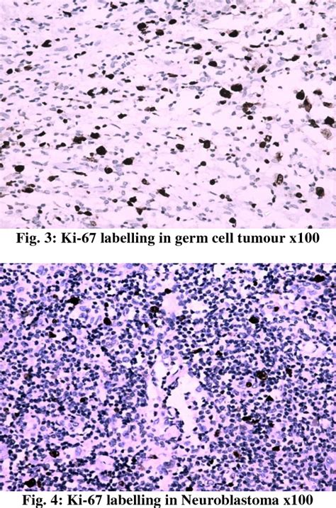 Table From Comparative Immunohistochemical Analysis Of Ki In A