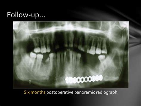 Chronic Osteomyelitis Of The Mandible Case Report Ppt Free Download