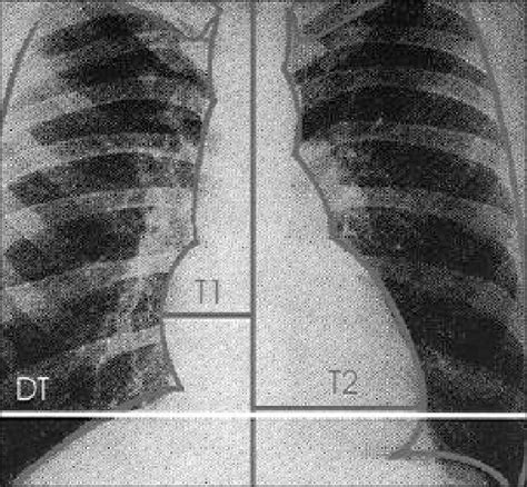 Conventional Chest Radiography The Cardiothoracic Ratio Was Obtained Download Scientific