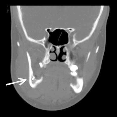 Ct Examination Of Head And Neck Sagittal Scan Soft Tissue Window