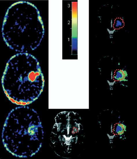 Nuclear Imaging Of Neuroinflammation Targeting Tspo Radiological