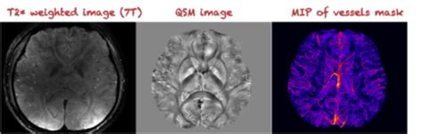 Quantitative Susceptibility Mapping QSM Center For Advanced