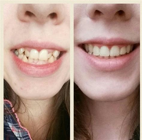 Before and after! : braces