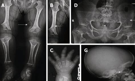 Achondroplasia Causes Signs Standard Therapies Prevention In