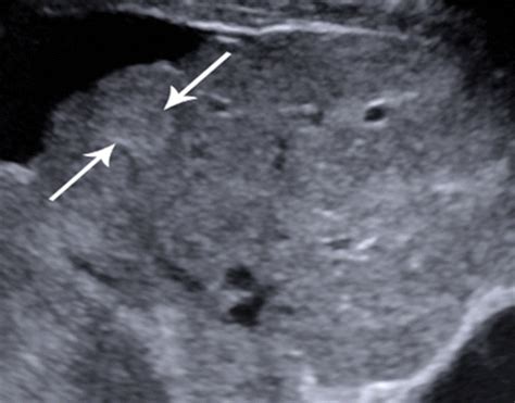 Radiographics Update Contrast Enhanced Us Approach To The Diagnosis Of