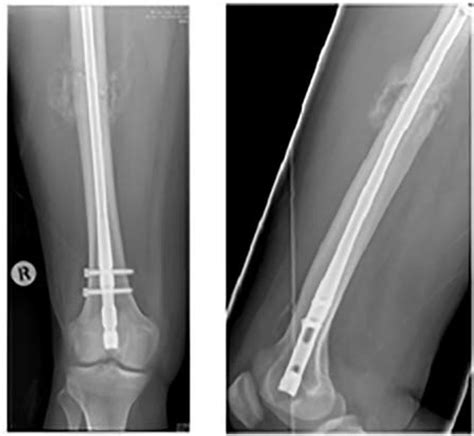 Intramedullary Nailing Femur Recovery Nail Ftempo