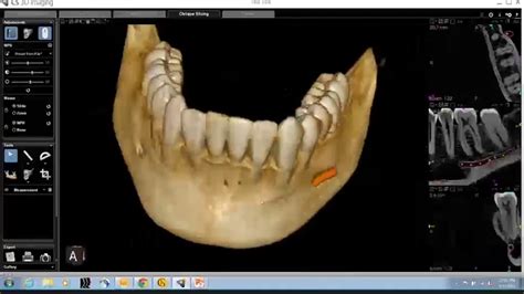 CS 3D Imaging Software Training CBCT Anatomical Review Of The Mandible