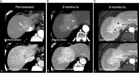 65 Year Old Male Cirrhosis Complicated By Hepatocellular Carcinoma A