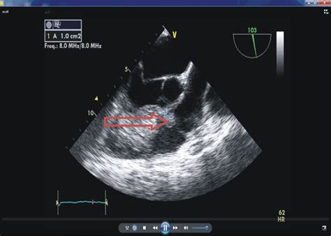 Trans Esophageal Echocardiography In The Mid Esophageal View Of Right