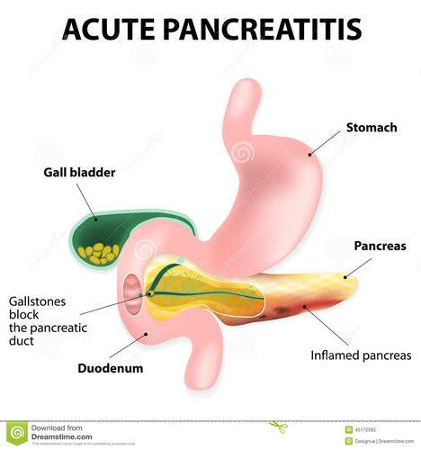 Pancreatic Disorders Flashcards Quizlet