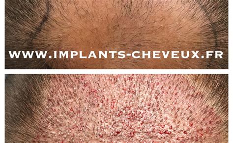 Résultats capillaire en photos micro greffe de cheveux FUE