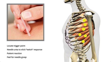 Dry Needling Trigger Point Release Shoulder Pain Serratus Anterior Youtube