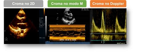 Dicas Para Otimizar A Imagem Ecocardiográfica Bidimensional 2d Parte 4 Blog Ecope