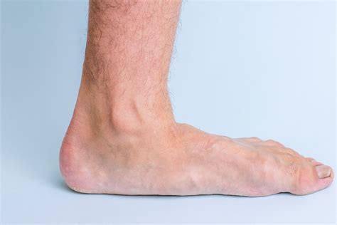 Flat Feet And Fallen Arches By Steady Gait Foot Clinic