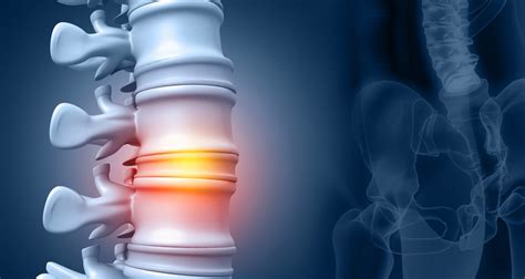 Informativo Sobre Espondilose Dorsal Itc Vertebral