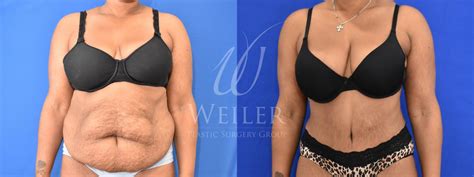 Tummy Tuck Before And After Pictures Case 867 Baton Rouge New