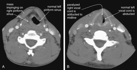 Imaging Soft Tissues Of The Neck Radiology Key