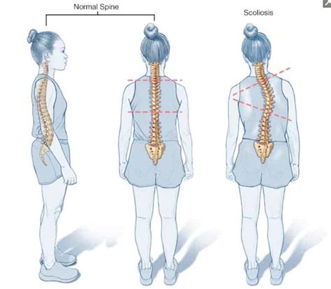 Escoliosis Lumbar Diagn Stico Causas Y Tratamiento