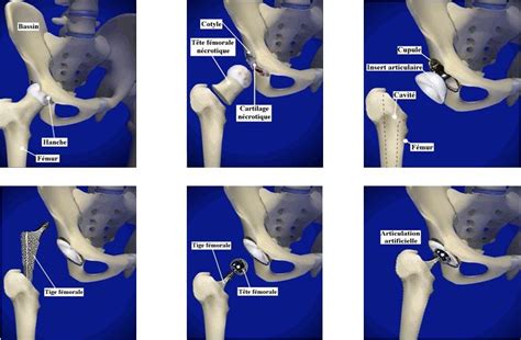 5 Arthroplastie de la prothèse totale de hanche Download Scientific