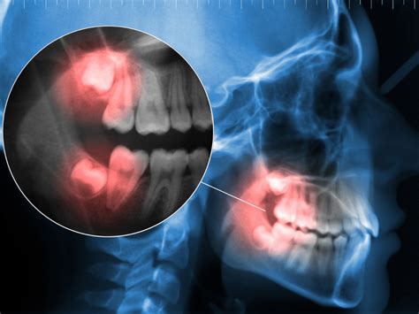 Dente Do Siso Informa Es Importantes Agenda Consulta