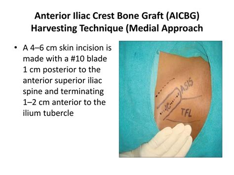 Anterior Iliac Crest Ppt