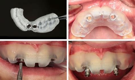 Cirugía guiada en implantes Expertos en implantología guiada por