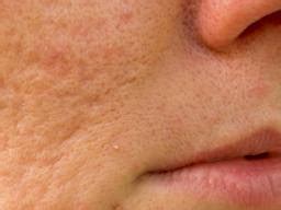 Facial Hair Labia Acne Period Telegraph