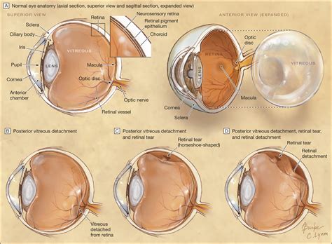 Acute Onset Floaters And Flashes Is This Patient At Risk For Retinal