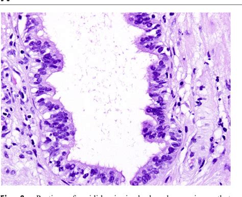 Epididymal Cyst Histology