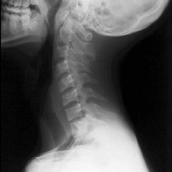 Plain Cervical Spine Lateral View Radiograph Shows No Abnormality And