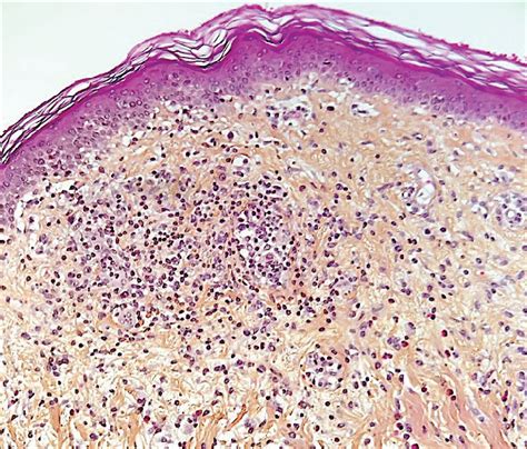 Morbilliform Maculopapular Eruption Histopathology Shows Mild Dermal