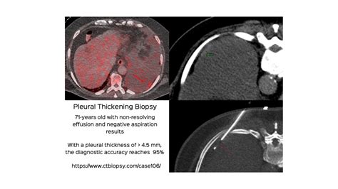 Case 106 Pleural Thickening Biopsy