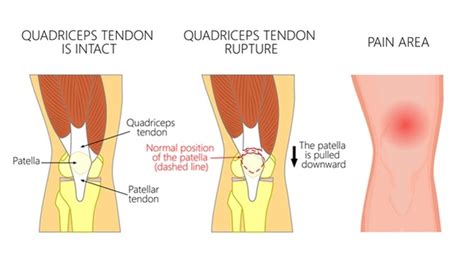 Quadriceps Tendon Tear Physiopedia