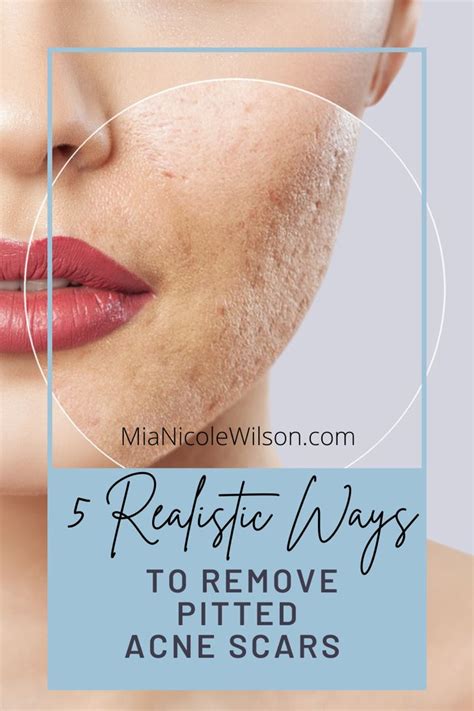 How To Get Rid Of Acne Scars According To Dermatologists Artofit